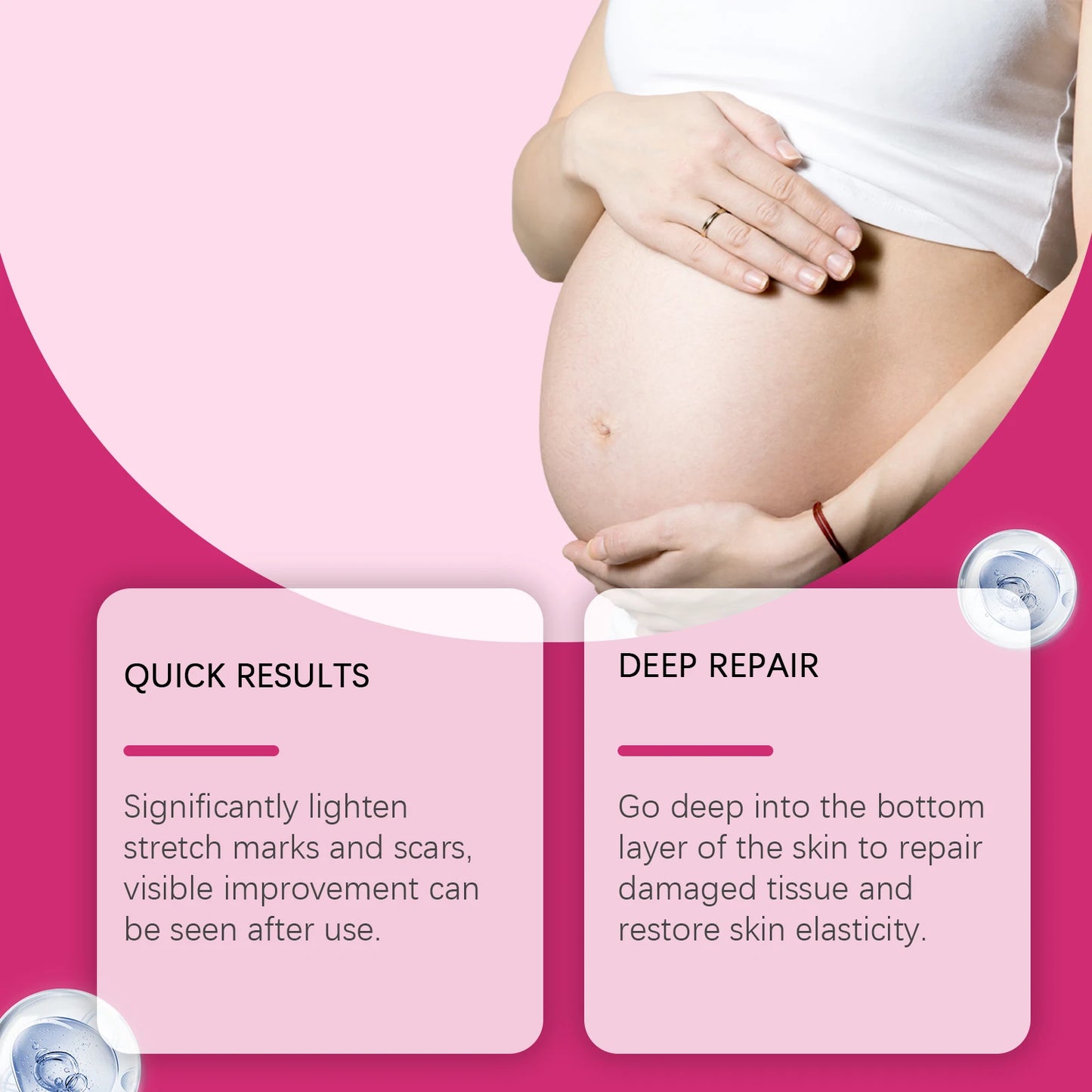Stretch Marks Removal Lotion
